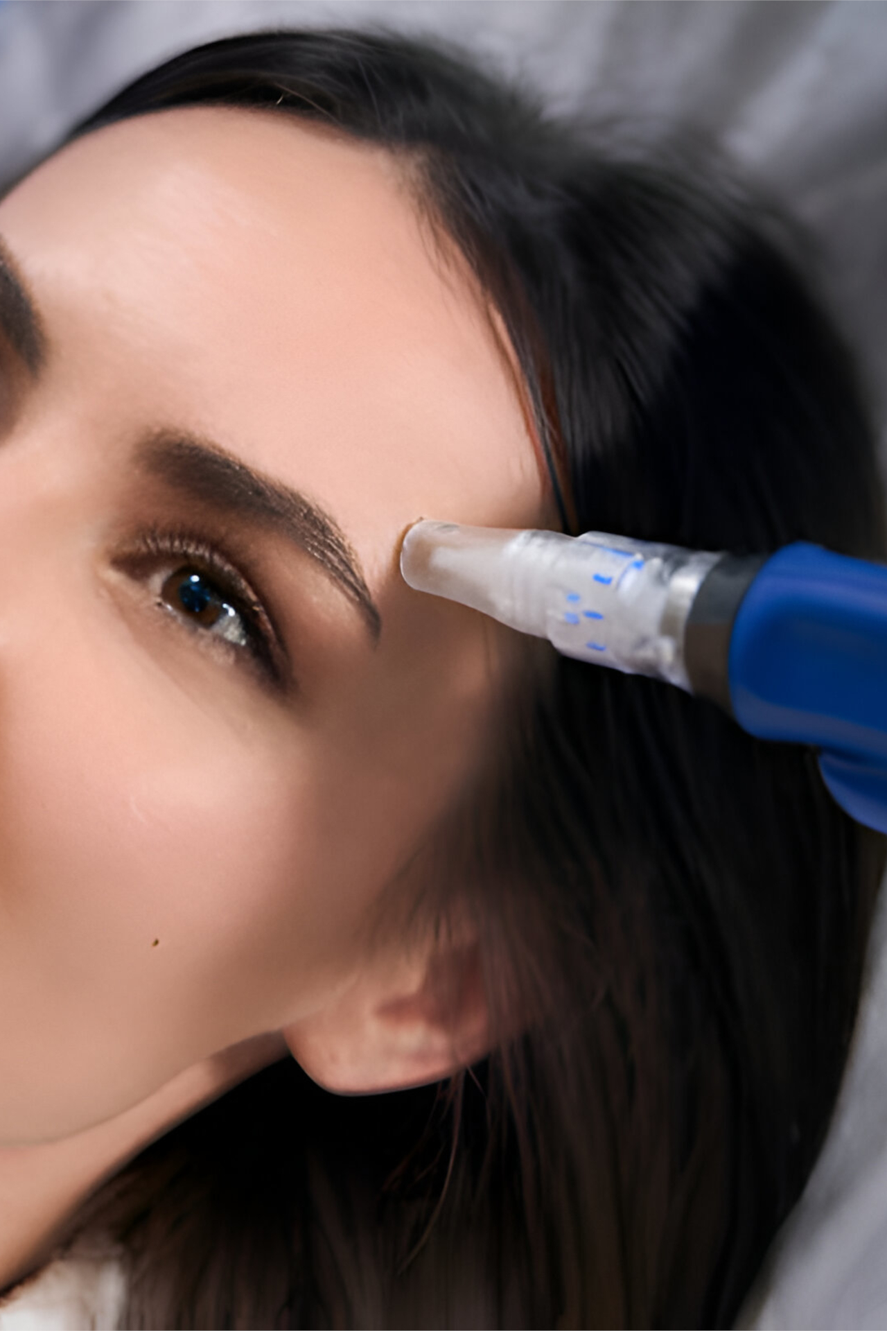 Microneedling